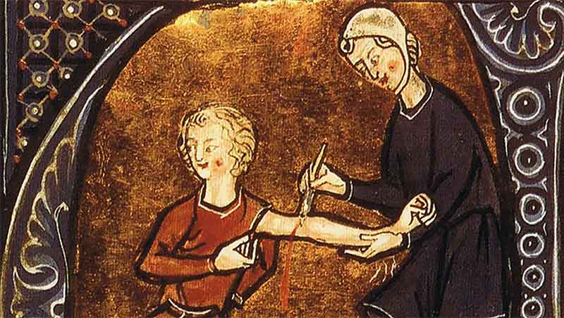 Åderlåtning av medeltida barberare